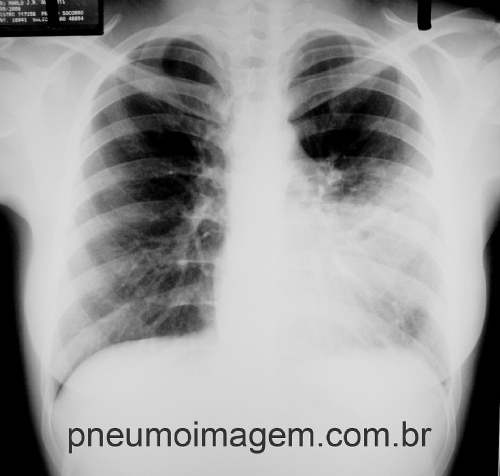 TEMPO EXCESSIVO DE USO DE ANTIBI�TICOS EM PNEUMONIA PODE CAUSAR DANOS